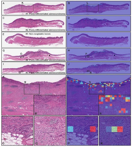 超レア】胃がんperspective 3 2013 Vol.6 No.1 超レア】胃がん