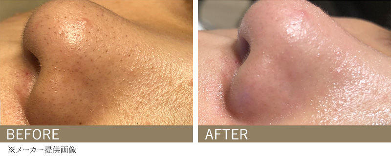 ハイドラフェイシャル｜大阪の美容皮膚科プライベートスキンクリニック