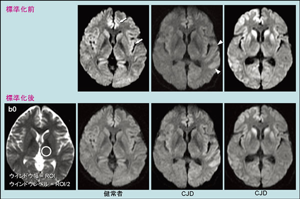 プリオン病のMRI画像診断の注意点