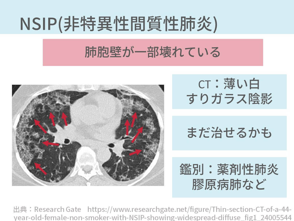 間質性肺炎を診断する方法【悲報：実はめちゃ難易度たかいです】※医療