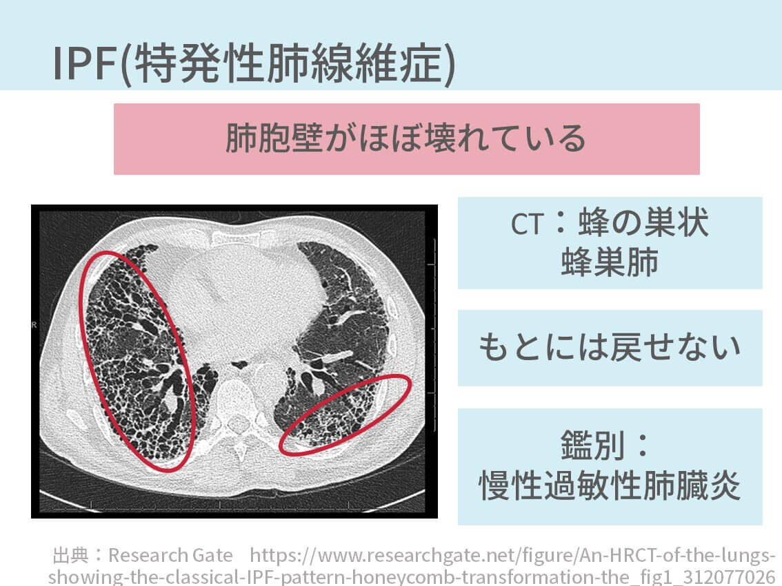 間質性肺炎を診断する方法【悲報：実はめちゃ難易度たかいです】※医療