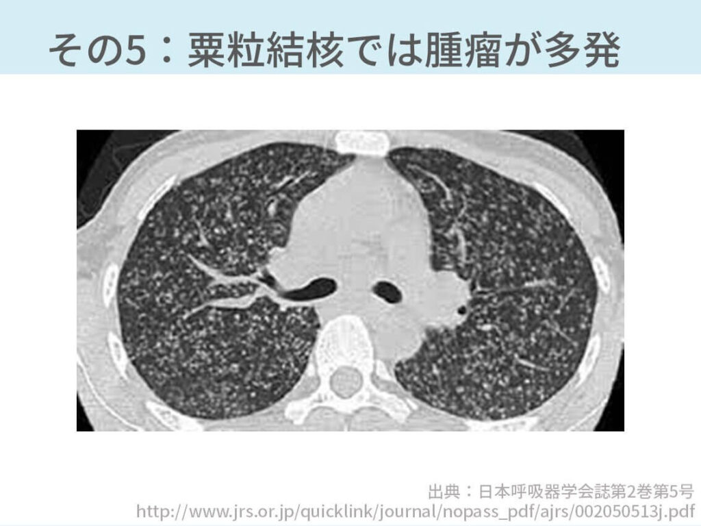 胸部CTの読影の基礎【働くのに必要な知識を最短で習得する方法