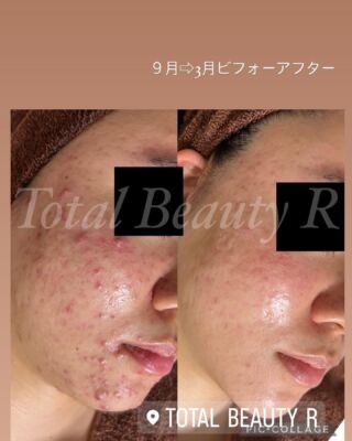 HQクリーム/HQ10クリーム