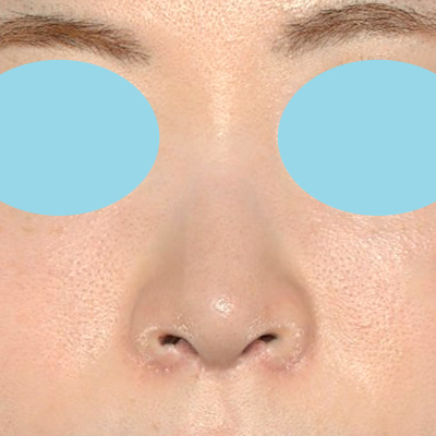 土手がなくなり小鼻が広がった30代女性の修正ビフォーアフター