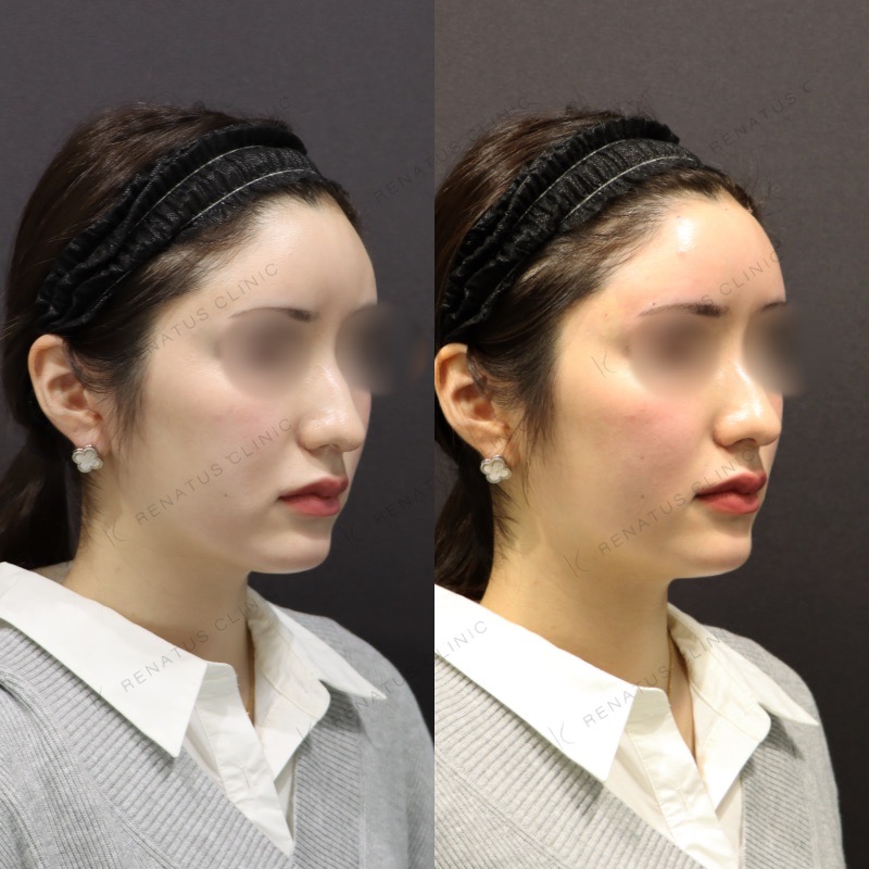 公式】額(おでこ)のヒアルロン酸注入