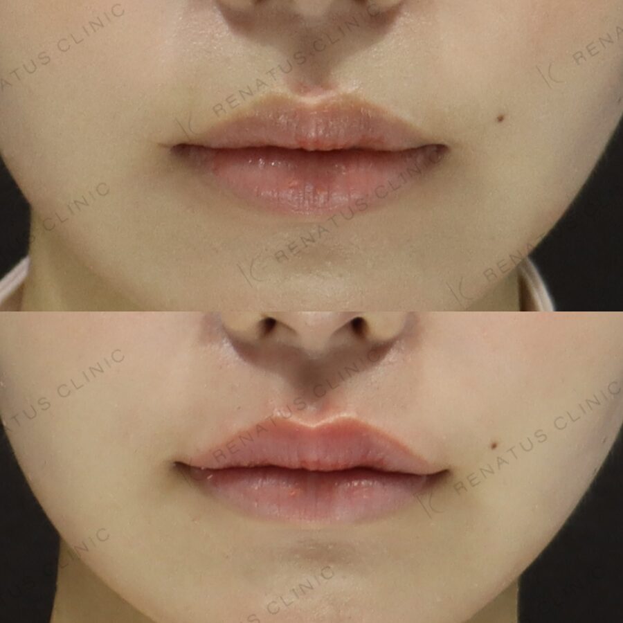 新宿で唇ヒアルロン酸ならレナトゥスクリニック