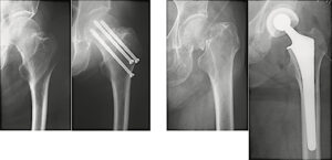 大腿骨近位部骨折｜基礎編 - リハスタ