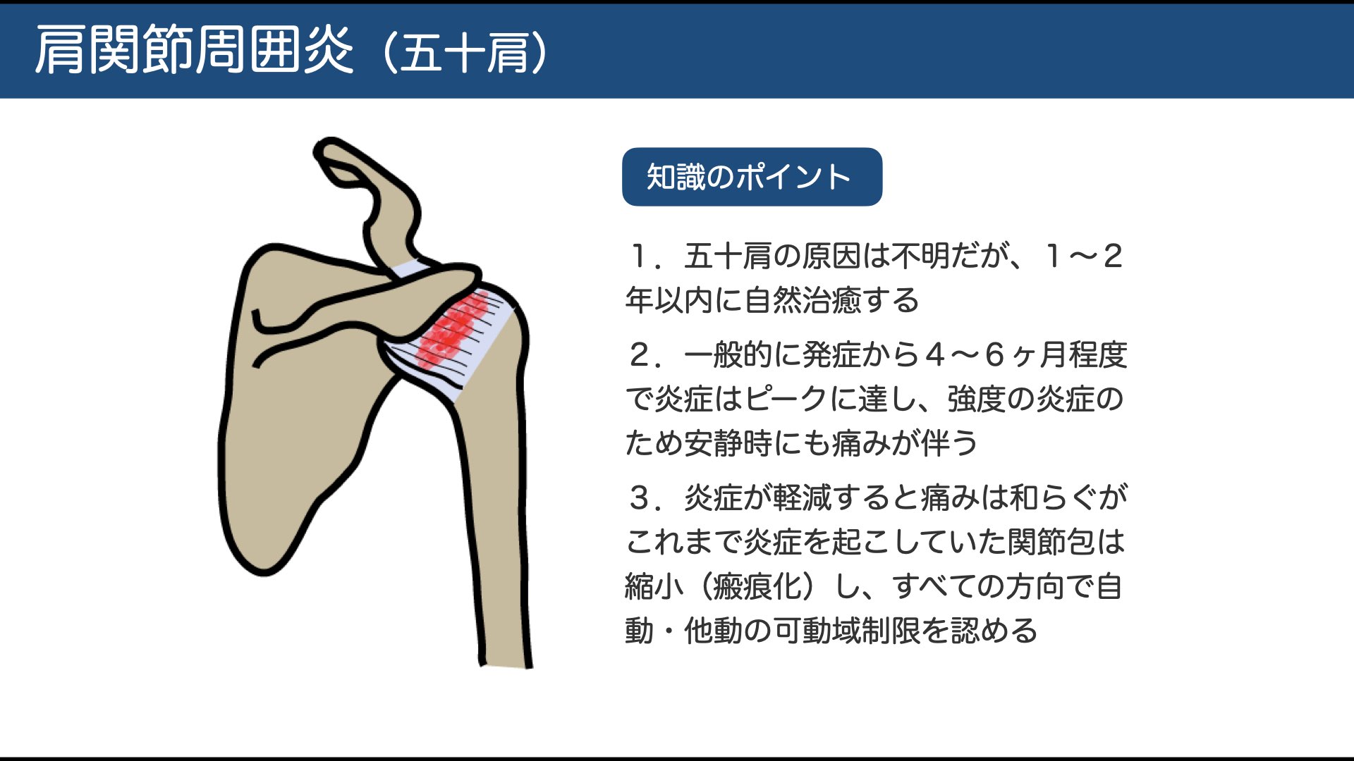 五十肩（肩関節周囲炎）の原因・病期と治し方