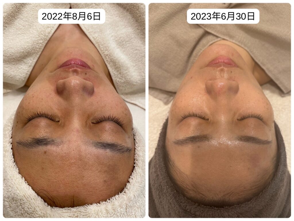 REVI ルヴィ ハーブピーリング Before&After | REVI導入ガイド