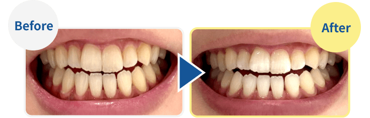 ホワイトニングについて ｜ RIMOBI（リモビ）｜オンライン診療で簡単
