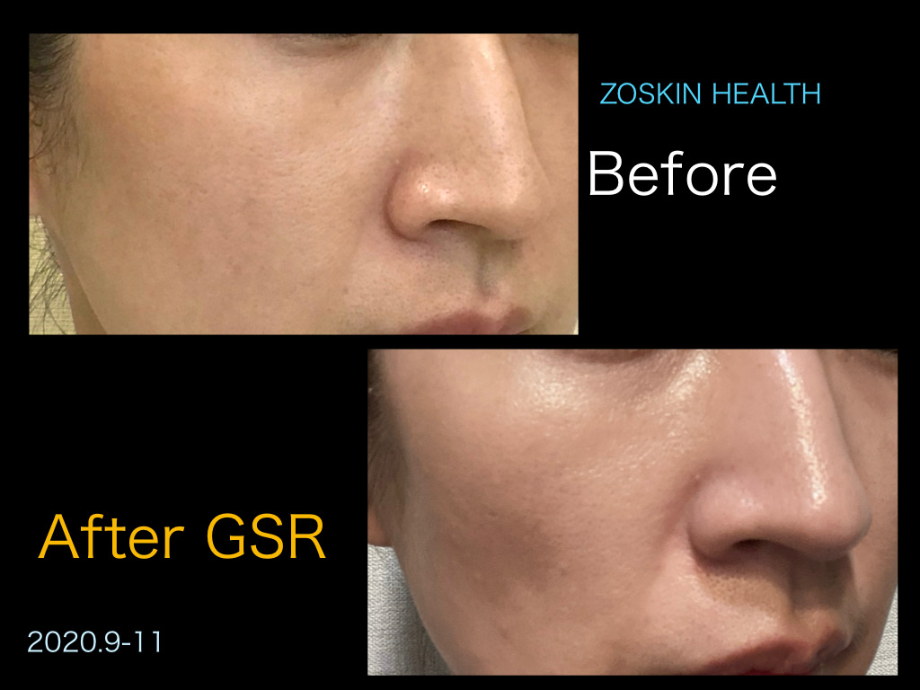 ゼオスキンヘルス新製品＋GSRの威力】 | Rパークサイド皮ふ科 | 福岡市