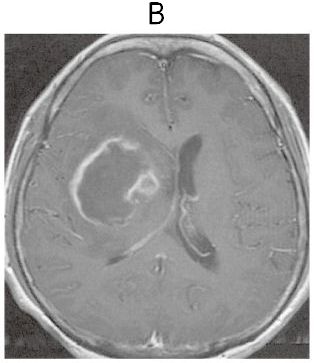 104I41 | 脳膿瘍 国試 | テコプラ