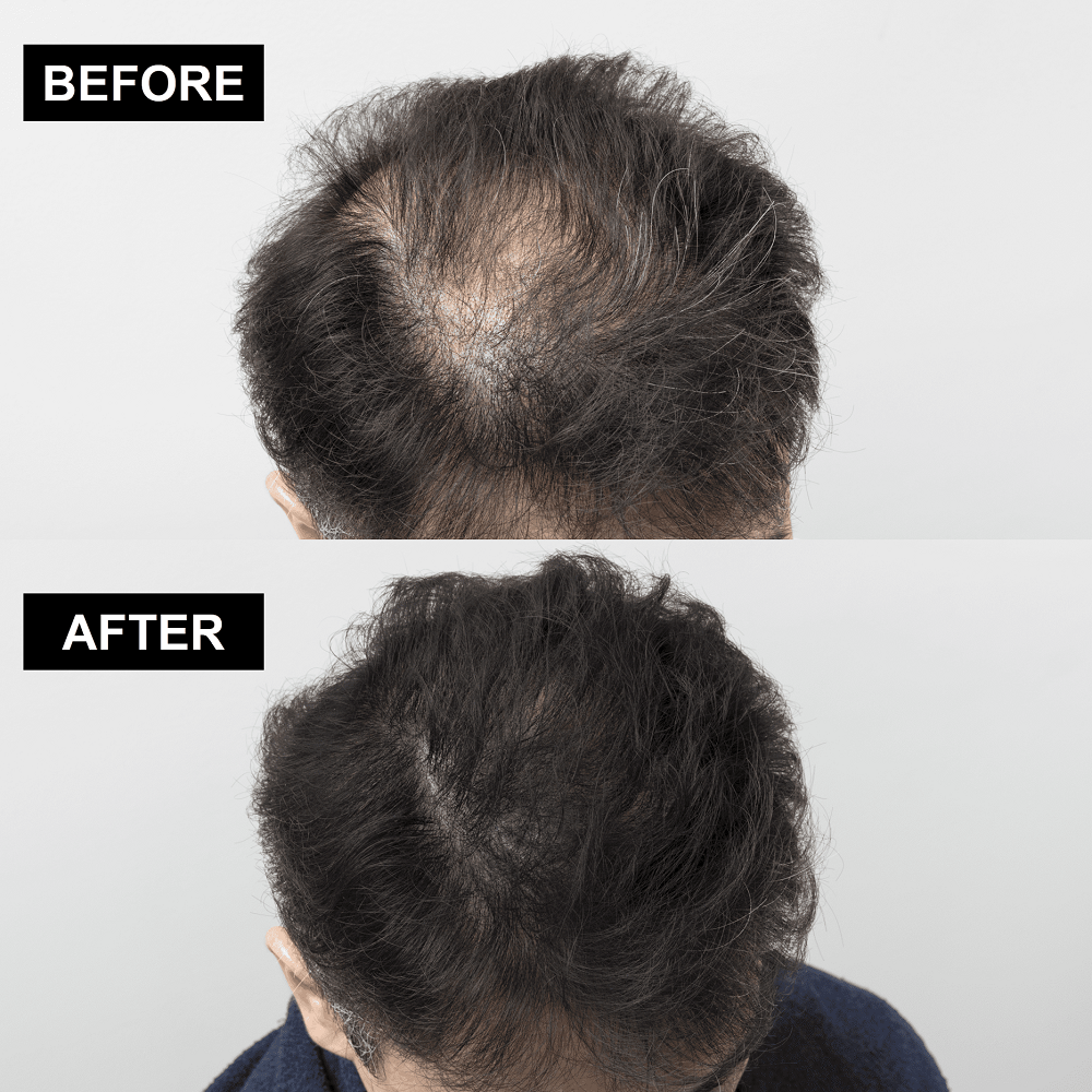 ヘアライズ ボリュームアップセット（ダークブラウン） | MSV