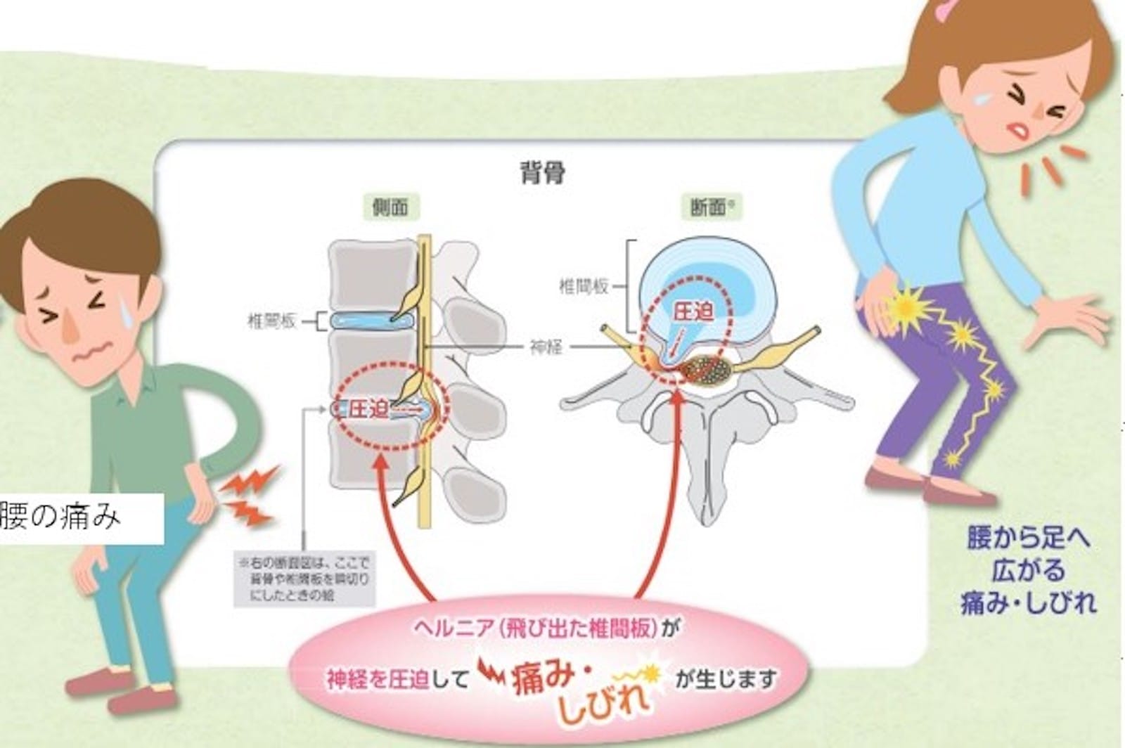 椎間板内酵素注入療法（ヘルニコア）