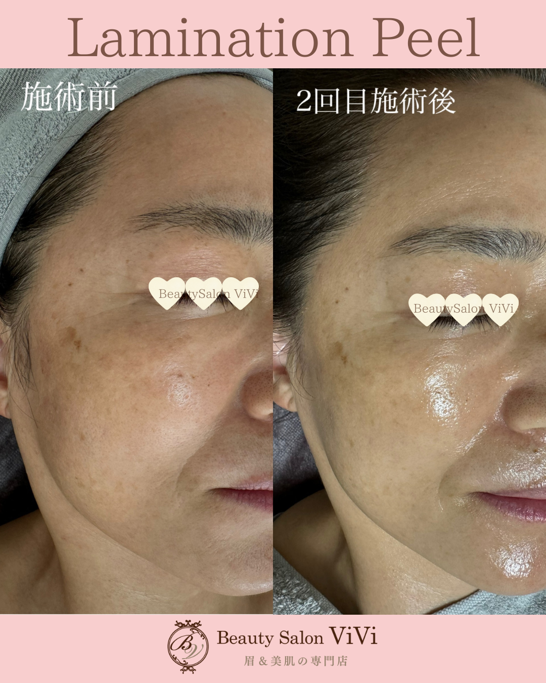 ラミネーションピール施術例♪ - フェイシャルエステ・毛穴洗浄・眉毛