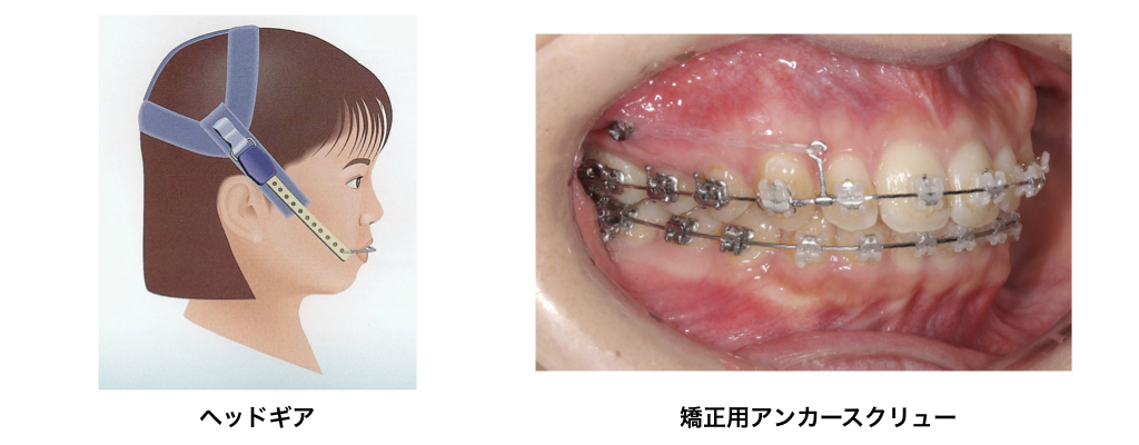 矯正用アンカースクリューについて | 佐賀駅前矯正歯科