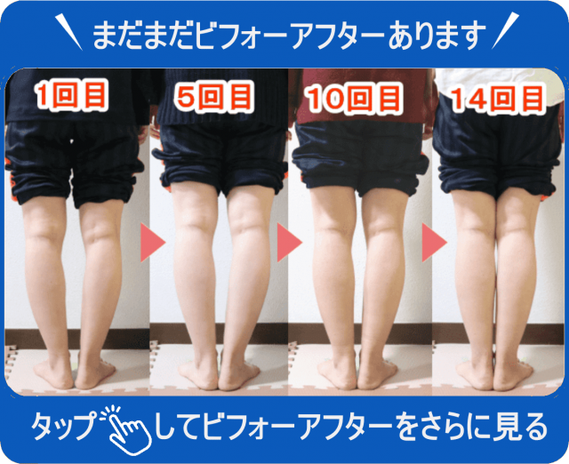 O脚矯正 | 新宿・笹塚のO脚、骨盤矯正「めぐみ整骨院」