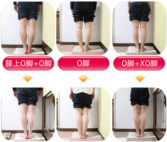 O脚矯正 | 新宿・笹塚のO脚、骨盤矯正「めぐみ整骨院」