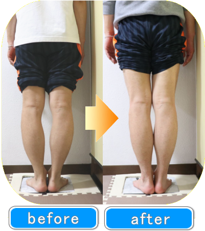 O脚矯正 | 新宿・笹塚のO脚、骨盤矯正「めぐみ整骨院」