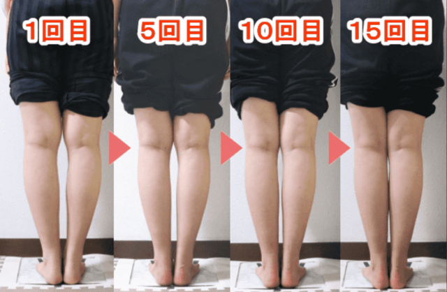 O脚・XO脚矯正ビフォーアフター・改善実績 | 新宿・笹塚のO脚、骨盤
