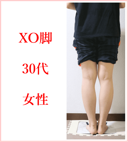 XO脚（膝下O脚）矯正 | 新宿・笹塚のO脚、骨盤矯正「めぐみ整骨院」