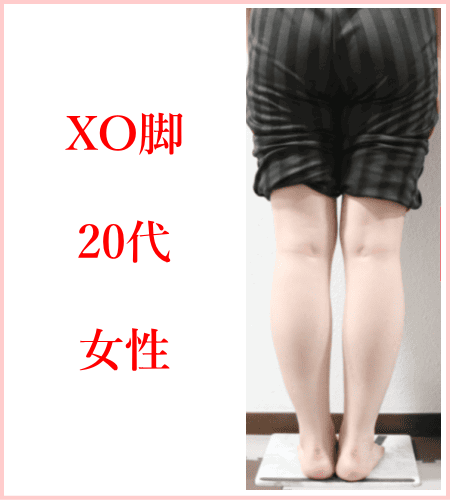 XO脚（膝下O脚）矯正 | 新宿・笹塚のO脚、骨盤矯正「めぐみ整骨院」