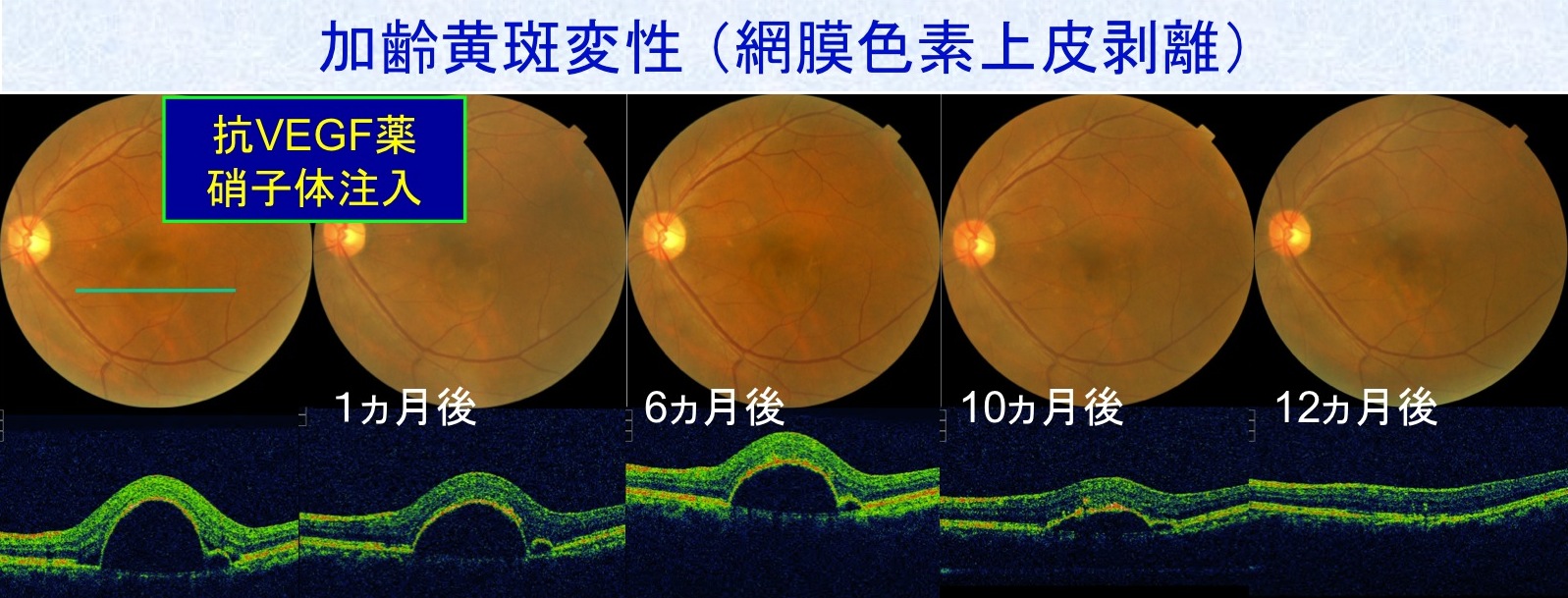 加齢黄斑変性 診療20のコツ 加齢黄斑変性 診療20のコツ【電子版