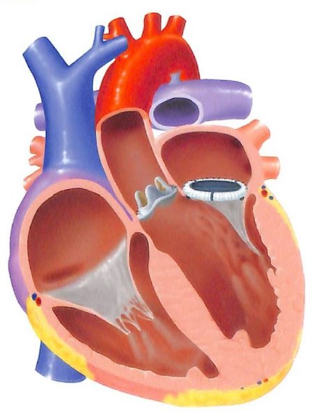 札幌医科大学附属病院 心臓血管外科（旧 第二外科） | 弁膜症