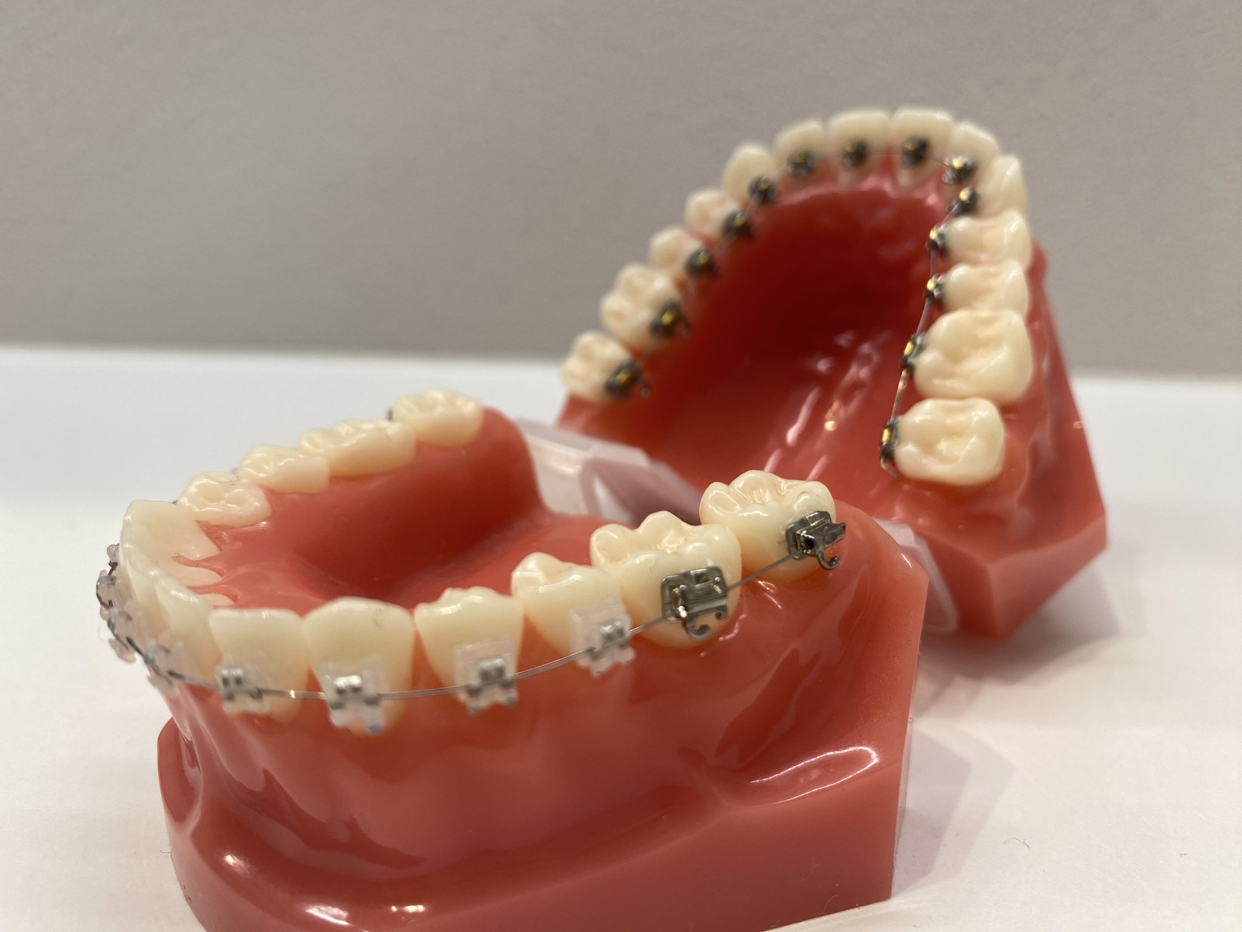 矯正治療で使うブラケットの役割と種類 | 札幌キュア矯正歯科