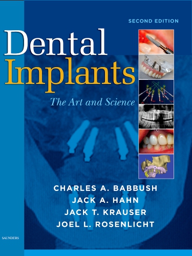 Dental Implants - 9781416053415