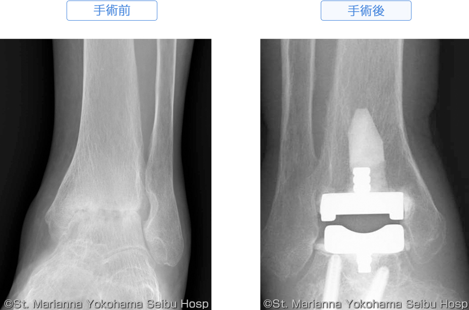 人工足関節 | 聖マリアンナ医科大学 横浜市西部病院