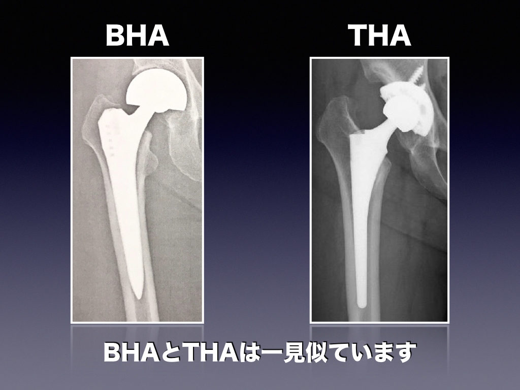 人工骨頭置換術とは │ 整形外科のいろいろ