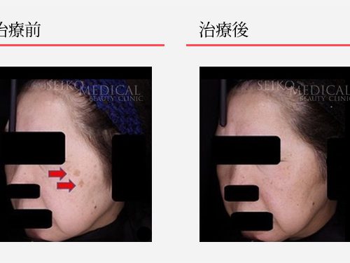 是非ミラミンだけでもお試しください | ゼオスキンヘルス｜セイコ