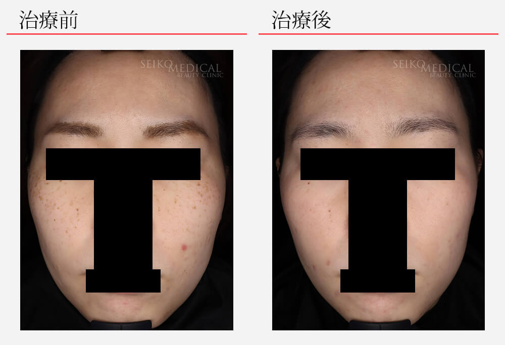 しみそばかすが5ヶ月でこんなに綺麗になりました | ゼオスキンヘルス