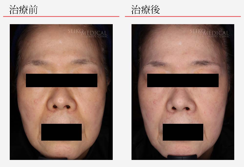 美白剤を使わず、デイリーPDとファーミングセラムでこんなに綺麗に