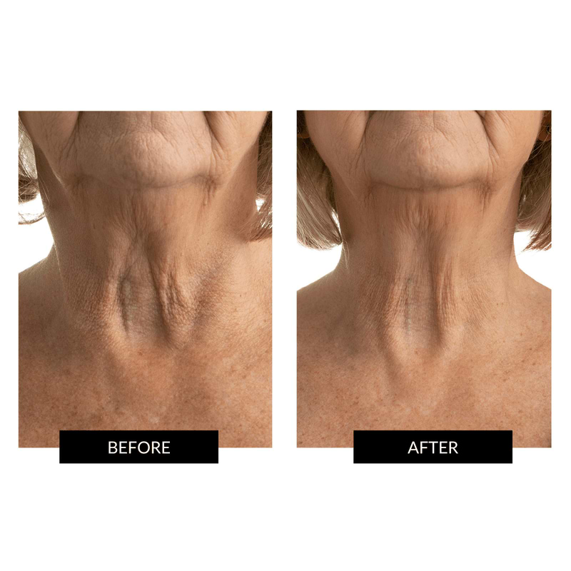 LED Neck and Dec Perfector | Chest Wrinkle Treatment | CurrentBody