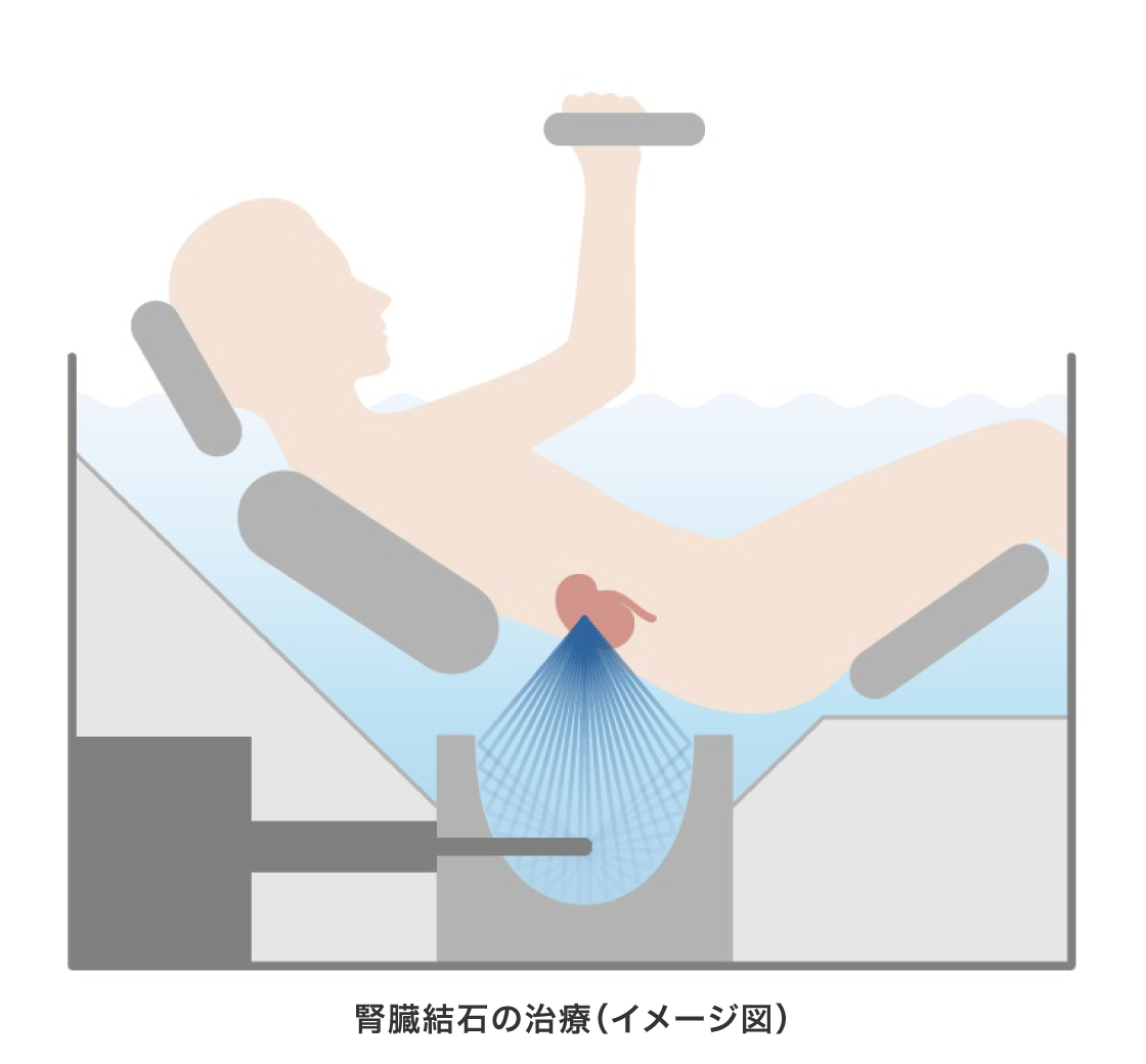 体外衝撃波について - 【公式】BTL-6000 フォーカス・BTL-6000 トップ