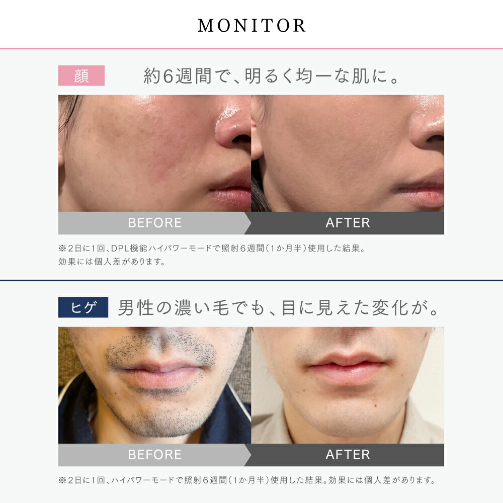 マラソン限定先着50名45%OFFクーポン！】リンチーリン愛用 脱毛器