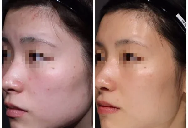 │シェリークリニック｜ニキビ治療に関するコラム