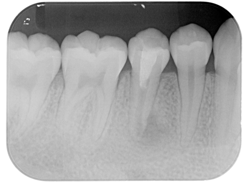 歯の根を育てたい方へ - 静岡の根管治療・歯内療法｜みしま歯内治療院