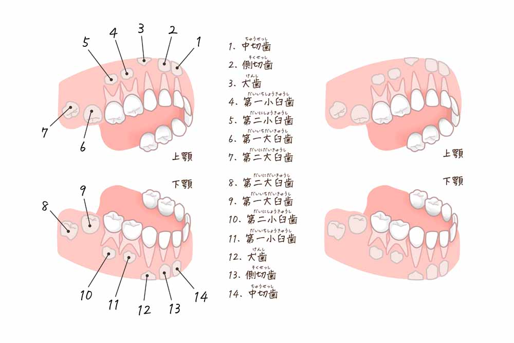 定期的なメンテナンスで早期発見！上顎第一大臼歯(6歳臼歯)の「異所