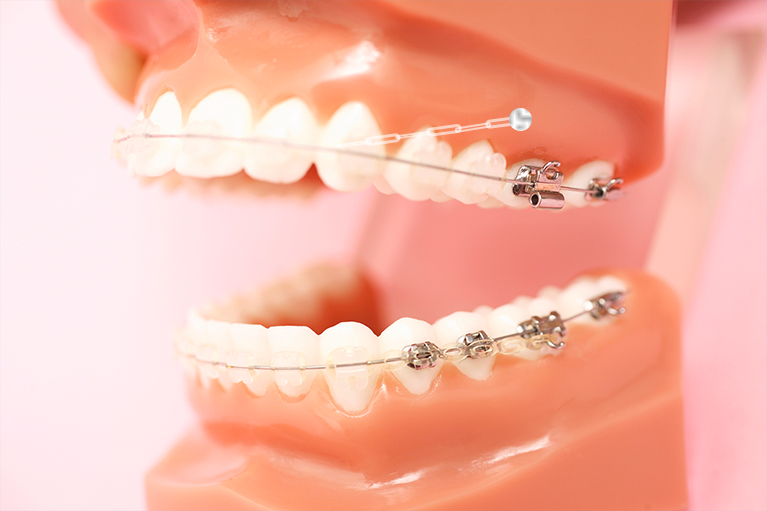 アンカースクリュー】矯正治療で使うネジってなに？ワイヤー矯正と併用
