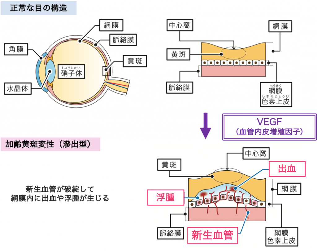 加齢黄斑変性 | 新小岩眼科