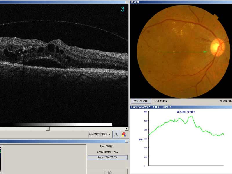 糖尿病網膜症 - 新川崎眼科｜川崎市幸区北加瀬