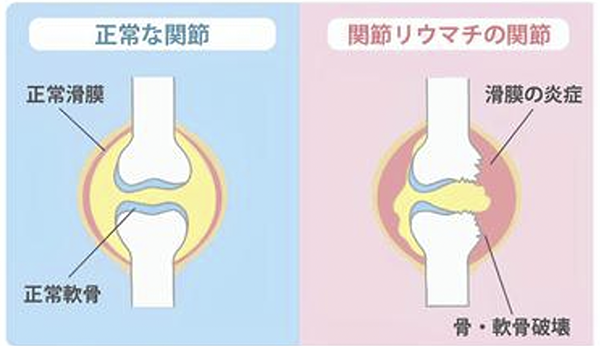 複数の関節の痛み – よくご相談いただく症状 ｜ 医療法人オアシス 福岡