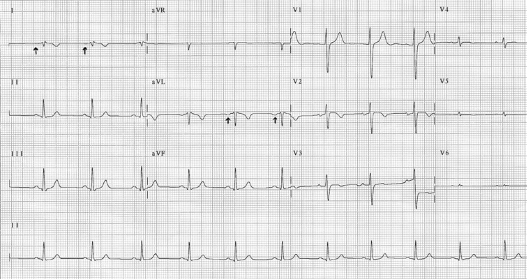 右胸心とは? | 心電図.com