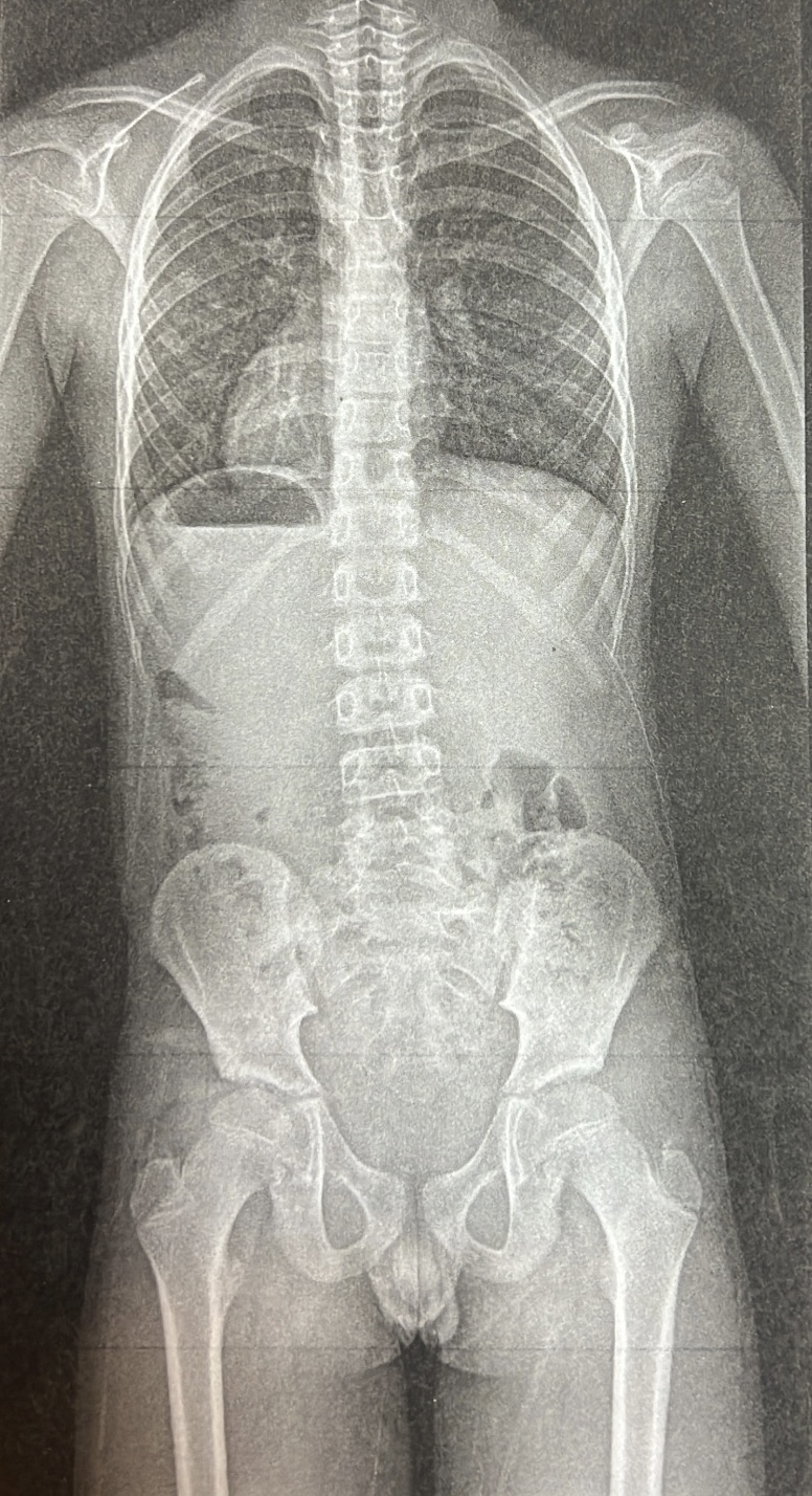 側弯症が完治に至るまで実施した運動を3つご紹介 | 浜松の鍼灸院 た