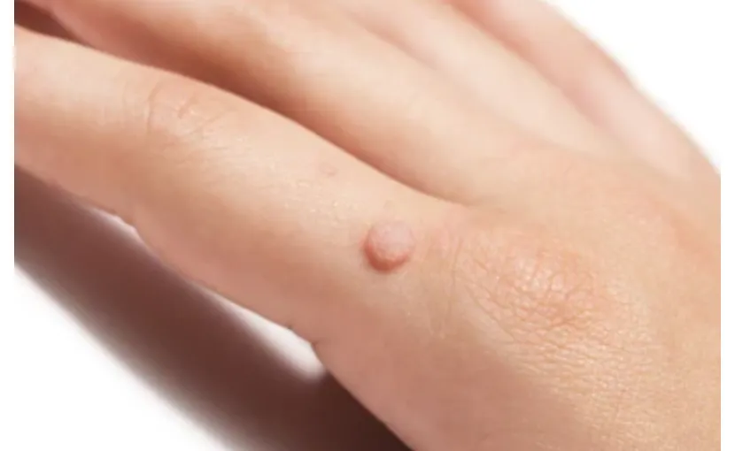 ウイルス性のイボ（尋常性疣贅）の原因と液体窒素や他の治療法について