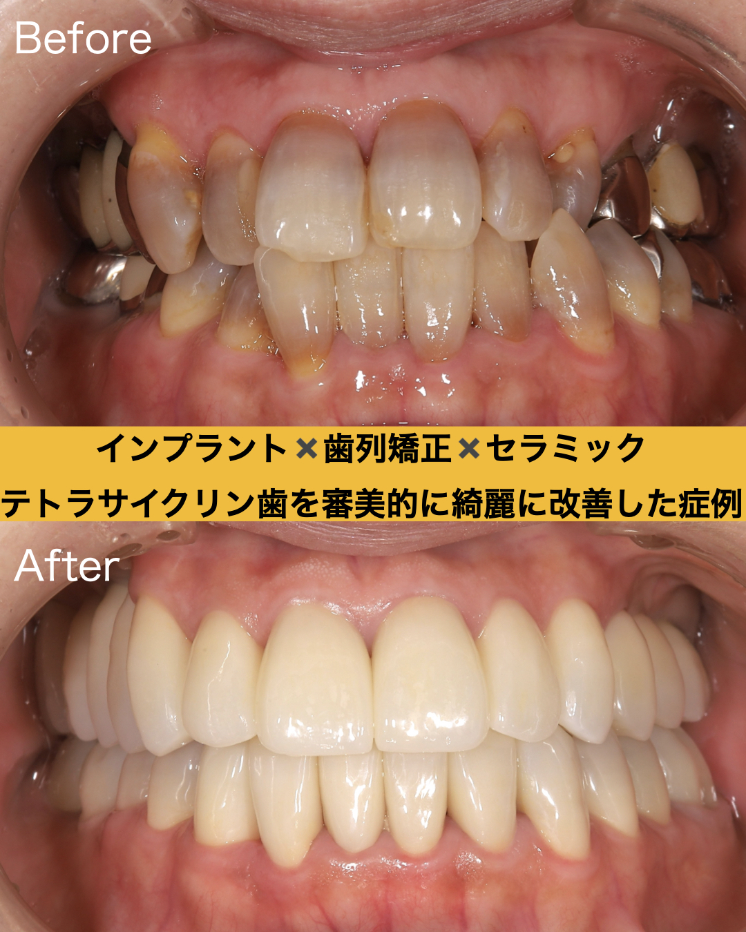 インプラントを大阪でするなら-帝塚山スマイルデザインクリニック