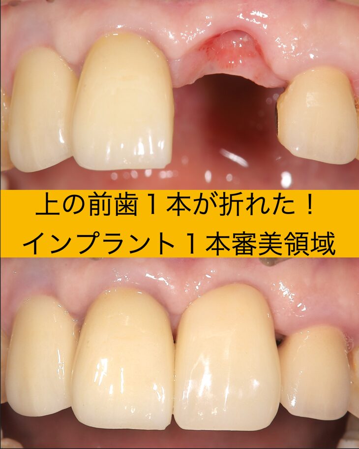 インプラントを大阪でするなら-帝塚山スマイルデザインクリニック